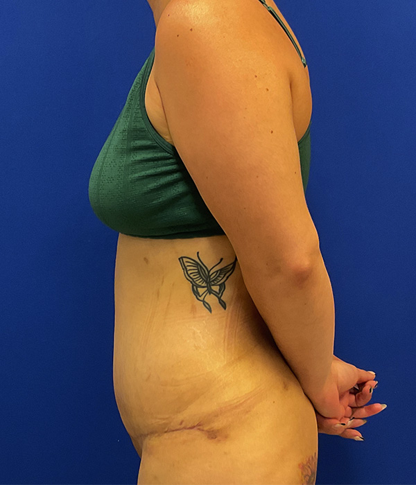 Tummy tuck with 360 liposuction 8 week after photo, left side view