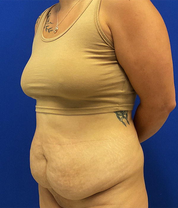 Tummy tuck with 360 liposuction before photo, left oblique view