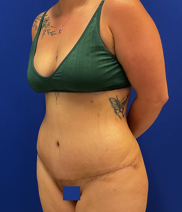 Tummy tuck with 360 liposuction 8 week after photo, left oblique view