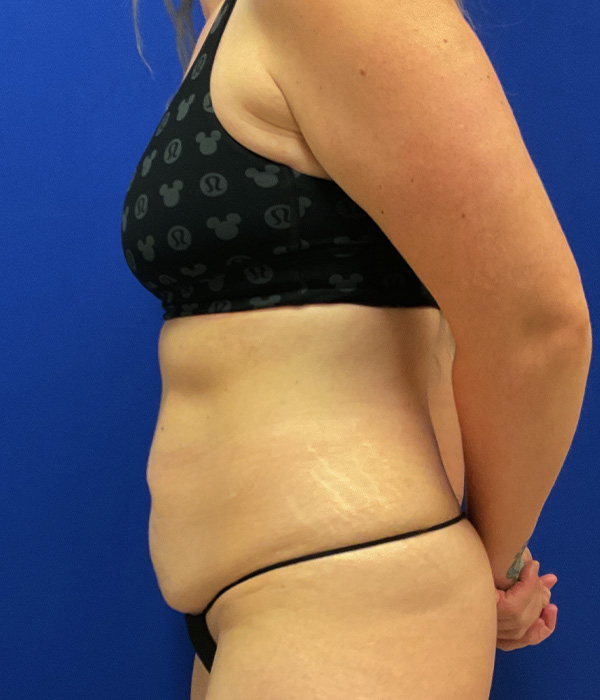 Tummy tuck with diastasis repair and circumferential liposuction before photo, left side view
