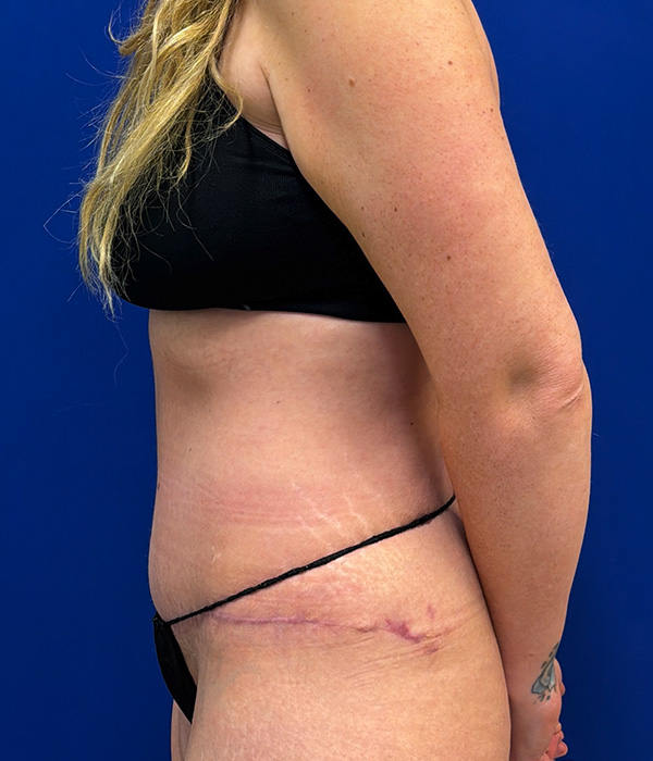 Tummy tuck with diastasis repair and circumferential liposuction 4 month after photo, left side view