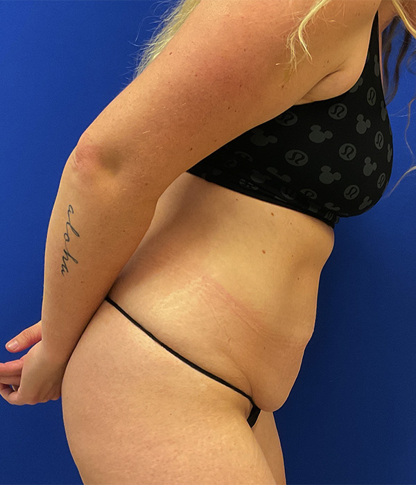 Tummy tuck with diastasis repair and circumferential liposuction before photo, right side view, bending forward