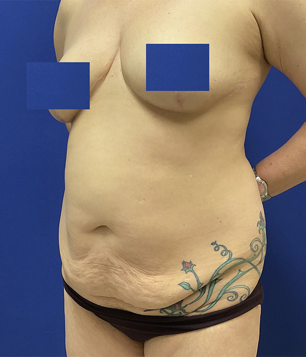 Tummy tuck (abdominoplasty) by Dr. Raj Iyengar - left oblique view before