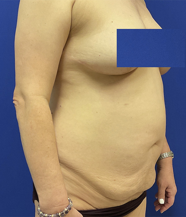 Tummy tuck (abdominoplasty) by Dr. Raj Iyengar - right oblique (second angle) view before