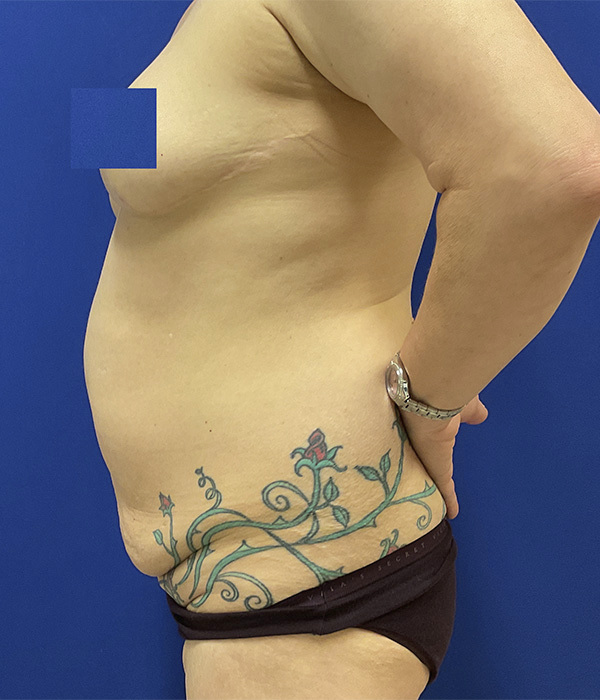 Tummy tuck (abdominoplasty) by Dr. Raj Iyengar - left side view before
