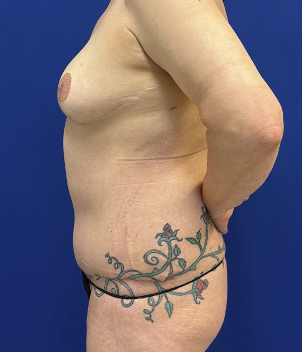 Tummy tuck (abdominoplasty) by Dr. Raj Iyengar - left side view after 6 weeks