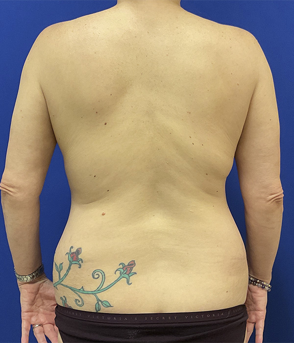 Tummy tuck (abdominoplasty) by Dr. Raj Iyengar - back view before