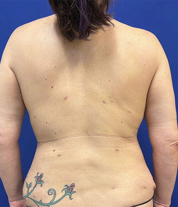 Tummy tuck (abdominoplasty) by Dr. Raj Iyengar - back view after 6 weeks