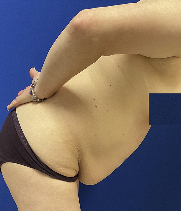 Tummy tuck (abdominoplasty) by Dr. Raj Iyengar - right bent view before