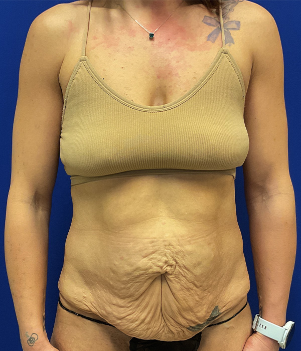 Tummy tuck (abdominoplasty) with diastasis repair and skin resection by Dr. Raj Iyengar - front view, before