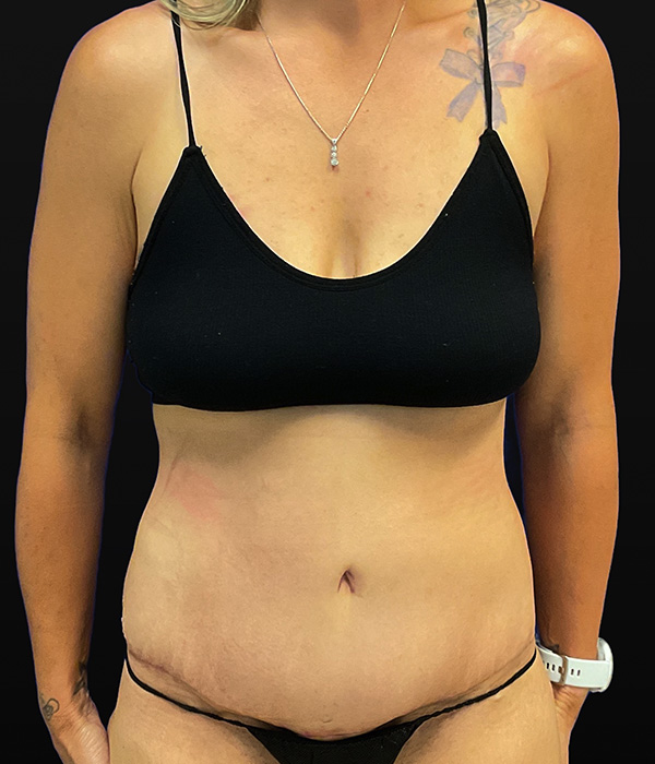 Tummy tuck (abdominoplasty) with diastasis repair and skin resection by Dr. Raj Iyengar - front view, after 2 months