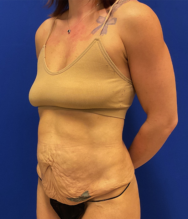 Tummy tuck (abdominoplasty) with diastasis repair and skin resection by Dr. Raj Iyengar - left oblique view, before