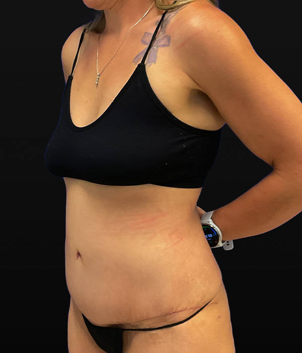 Tummy tuck (abdominoplasty) with diastasis repair and skin resection by Dr. Raj Iyengar - left oblique view, after 2 months