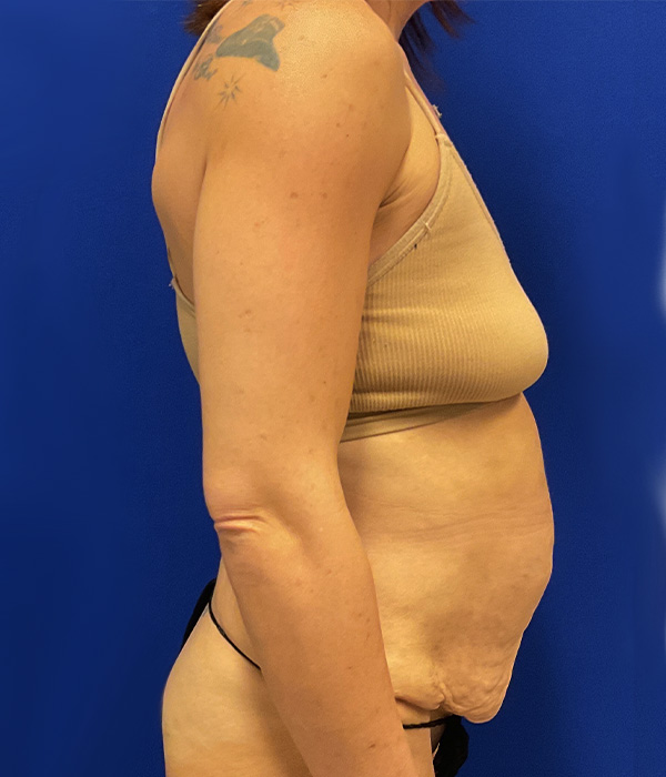 Tummy tuck (abdominoplasty) with diastasis repair and skin resection by Dr. Raj Iyengar - right side view, before