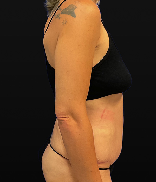 Tummy tuck (abdominoplasty) with diastasis repair and skin resection by Dr. Raj Iyengar - right side view, after 2 months