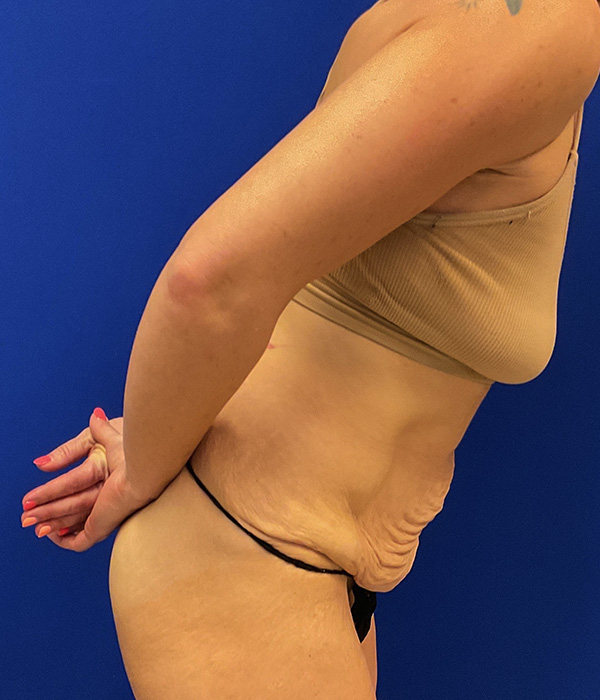 Tummy tuck (abdominoplasty) with diastasis repair and skin resection by Dr. Raj Iyengar - right side view, bending forward, before