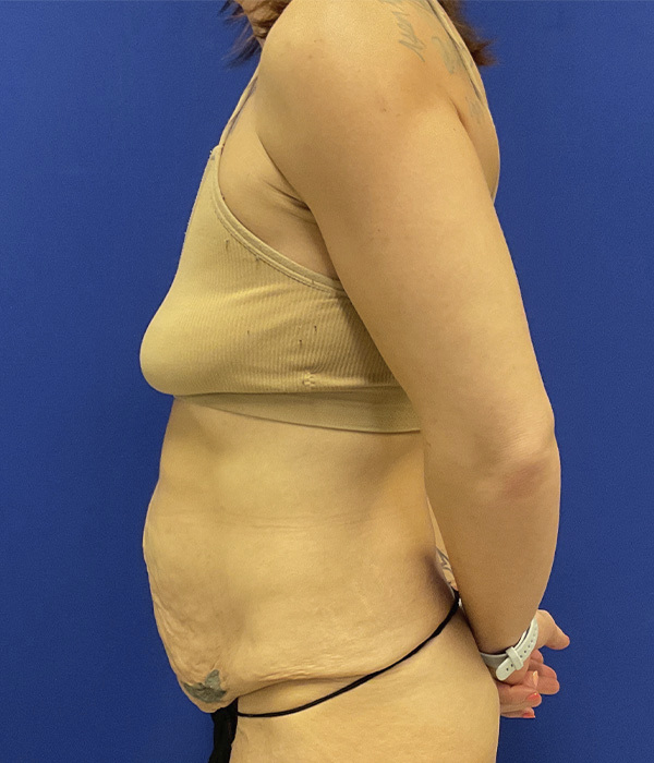 Tummy tuck (abdominoplasty) with diastasis repair and skin resection by Dr. Raj Iyengar - left side view, before