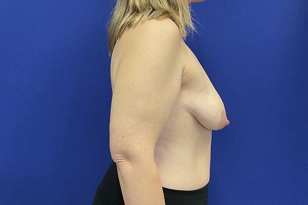 Breast augmentation with Motiva 340 cc implants and arm lift by Dr. Raj Iyengar - right side view before
