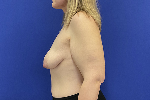 Breast augmentation with Motiva 340 cc implants and arm lift by Dr. Raj Iyengar - left side view before