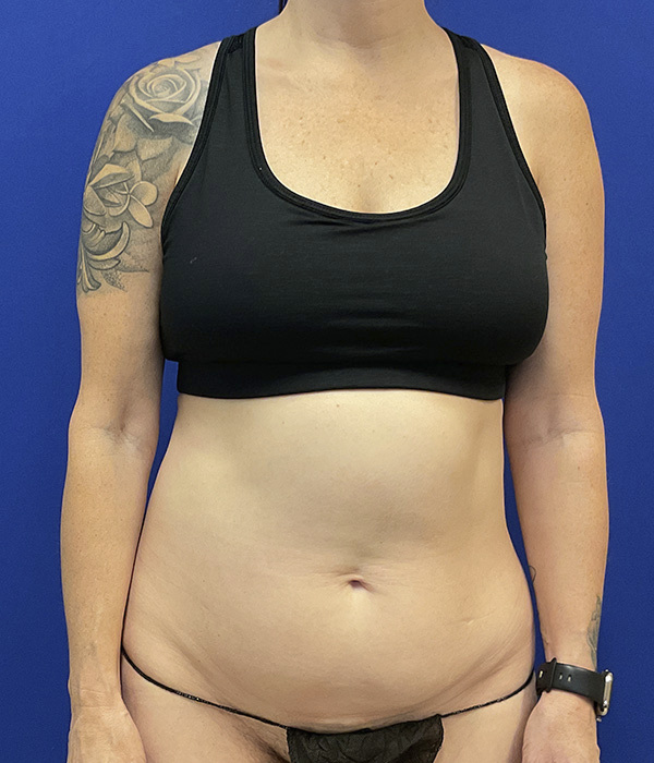 Tummy tuck by Dr. Raj Iyengar - front view before