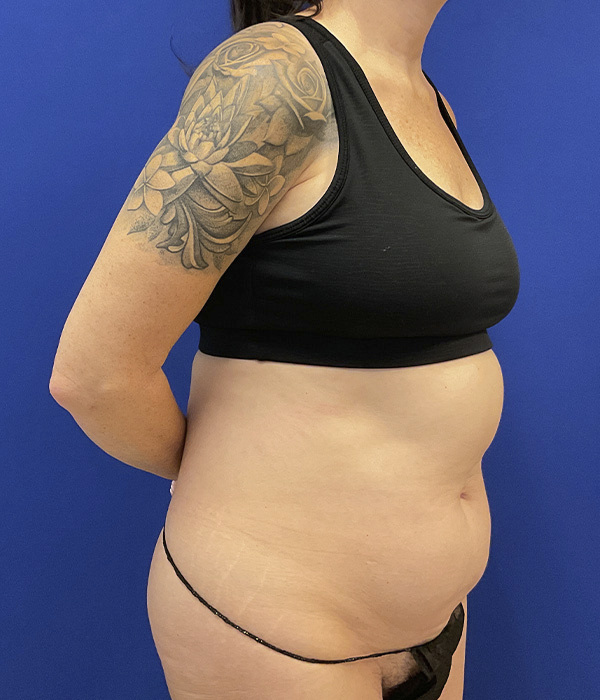 Tummy tuck by Dr. Raj Iyengar - right oblique view before