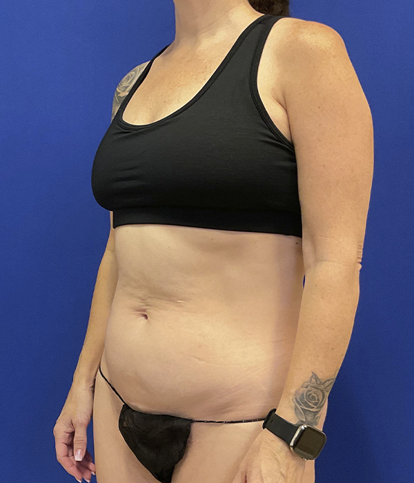 Tummy tuck by Dr. Raj Iyengar - left oblique view before