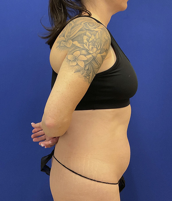Tummy tuck by Dr. Raj Iyengar - right side view before