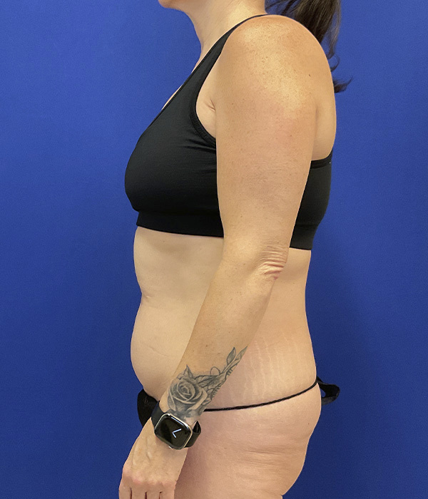 Tummy tuck by Dr. Raj Iyengar - left side view before