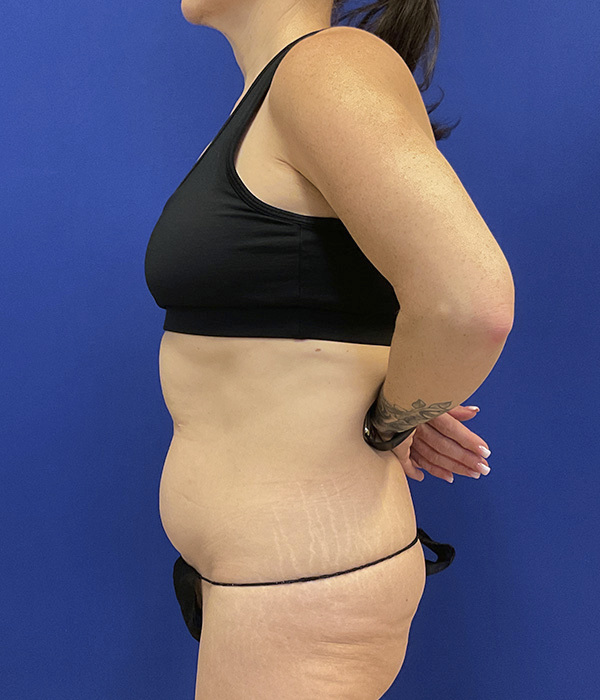 Tummy tuck by Dr. Raj Iyengar - left side view, arm behind back before