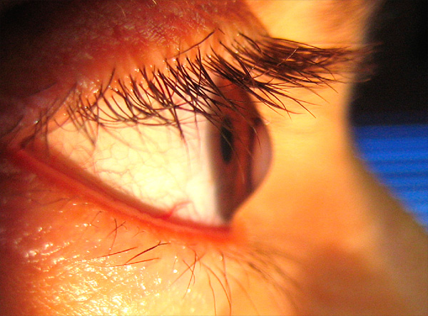 Specialty Contact Lenses for Keratoconus
