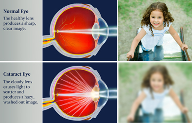 Protect your vision, know the 3 leading causes of blindness