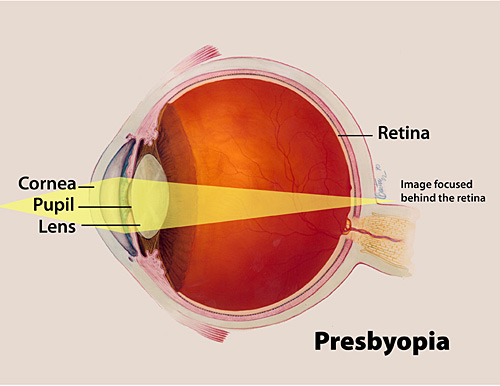 What is presbyopia?