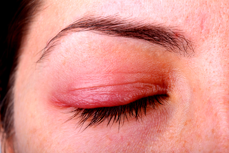 Ocular Rosacea: Causes and Treatment in Miami