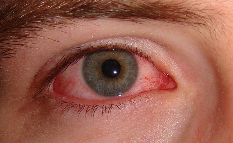 Sjogren’s Syndrome – Causes, Symptoms, and Treatment Options