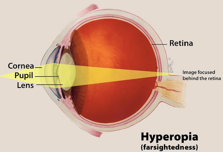 What Causes Farsightedness and What Are My Options to Fix It?