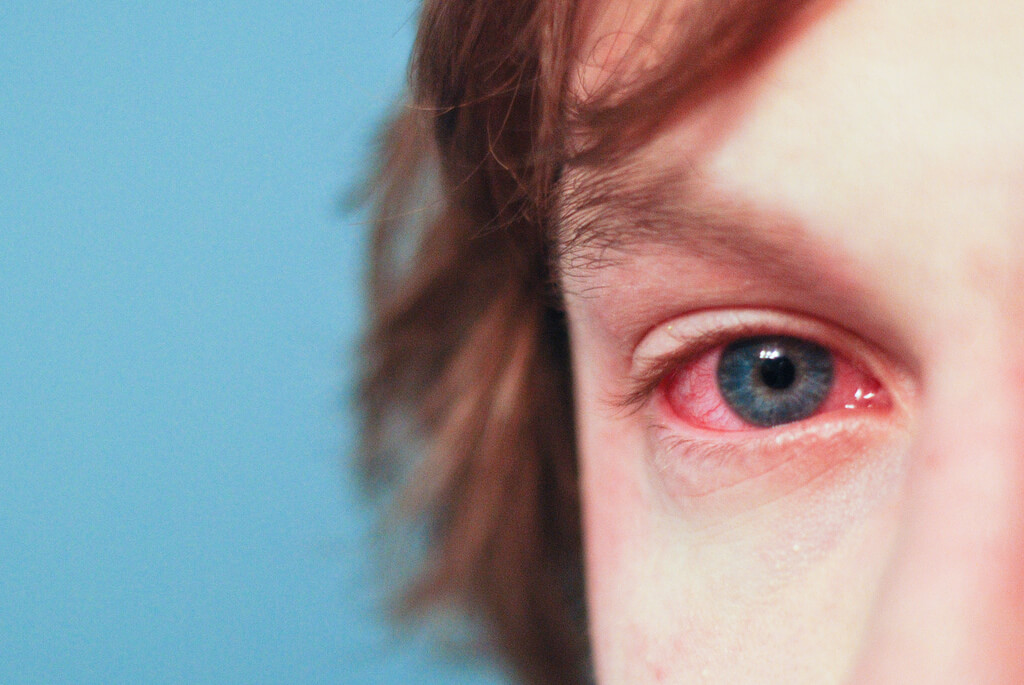 Contact Lenses and Spring Allergies