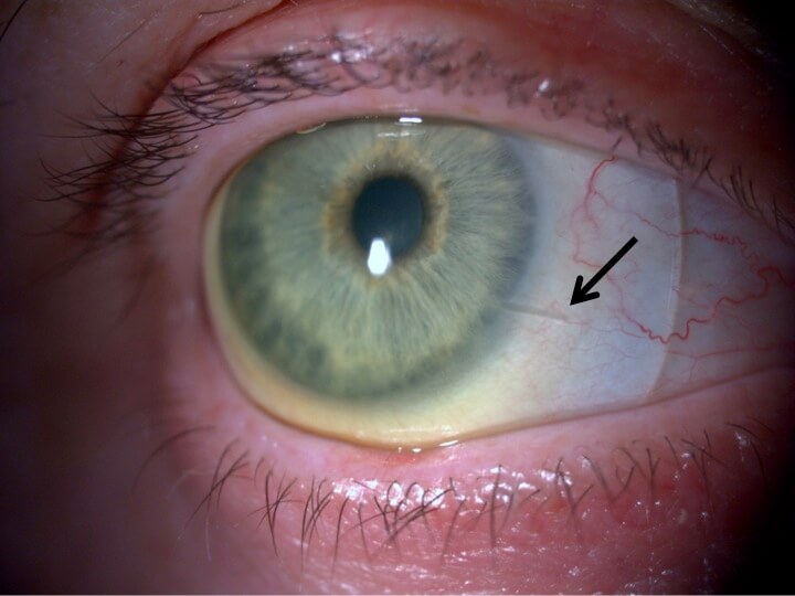 Am I a Good Candidate for Scleral Contact Lenses? Here's How to Find Out
