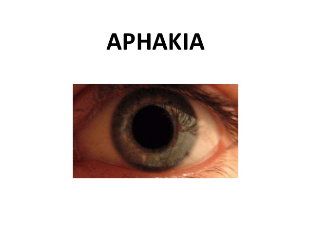 Aphakia: Symptoms, Causes and Treatments Available