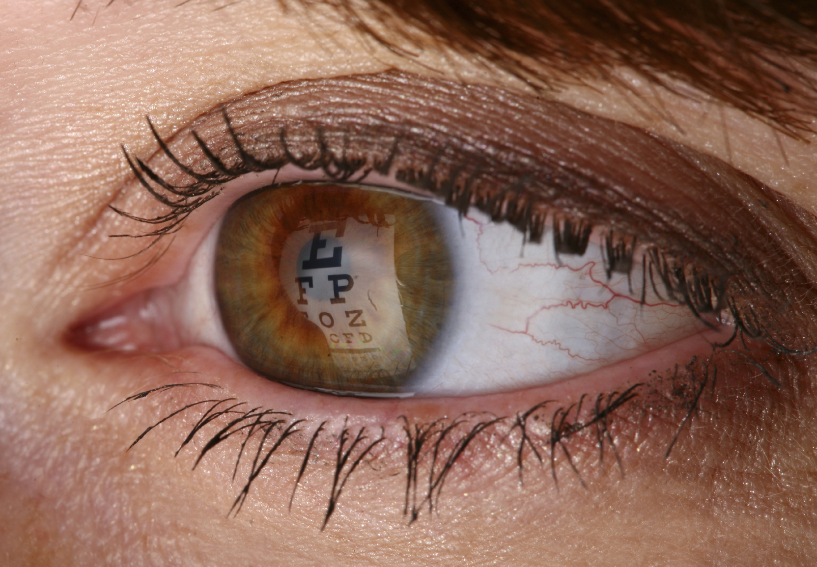 How an Optometrist Diagnoses Keratoconus Patients (and the Definitive Keratoconus Treatment)