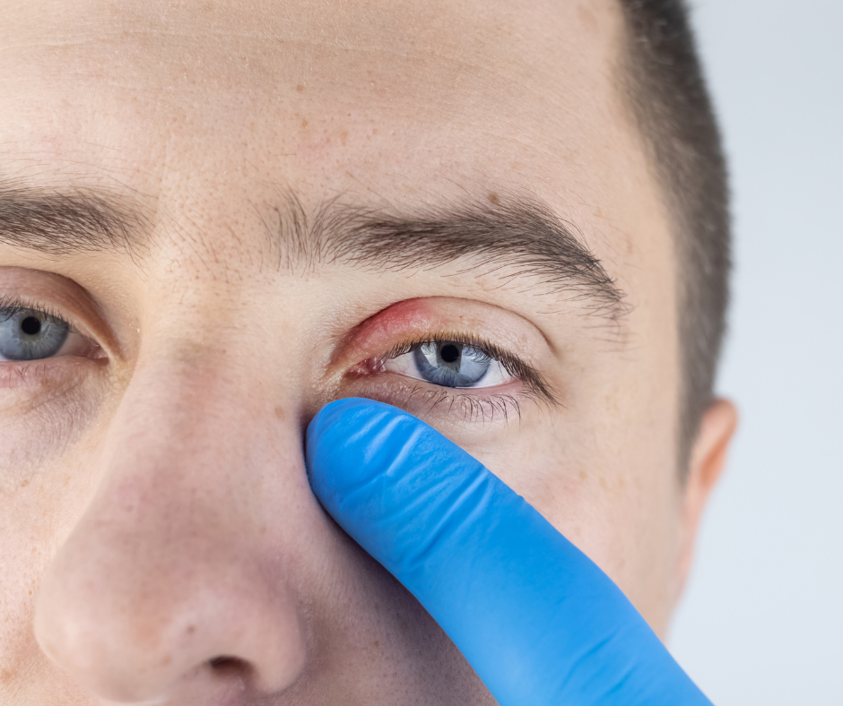 Blepharitis/Dry Eye Home Treatment