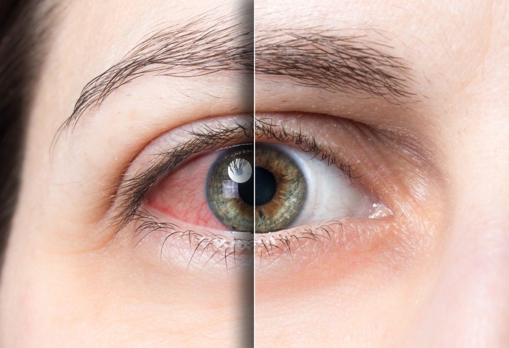Interview with Dr. Kramer for "Dry Eye to the Rescue"