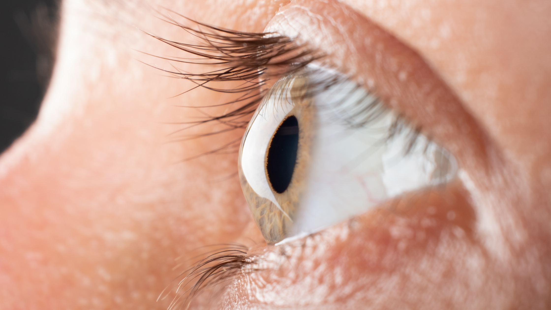 Understanding the Treatment Options If You Have Been Diagnosed with Keratoconus