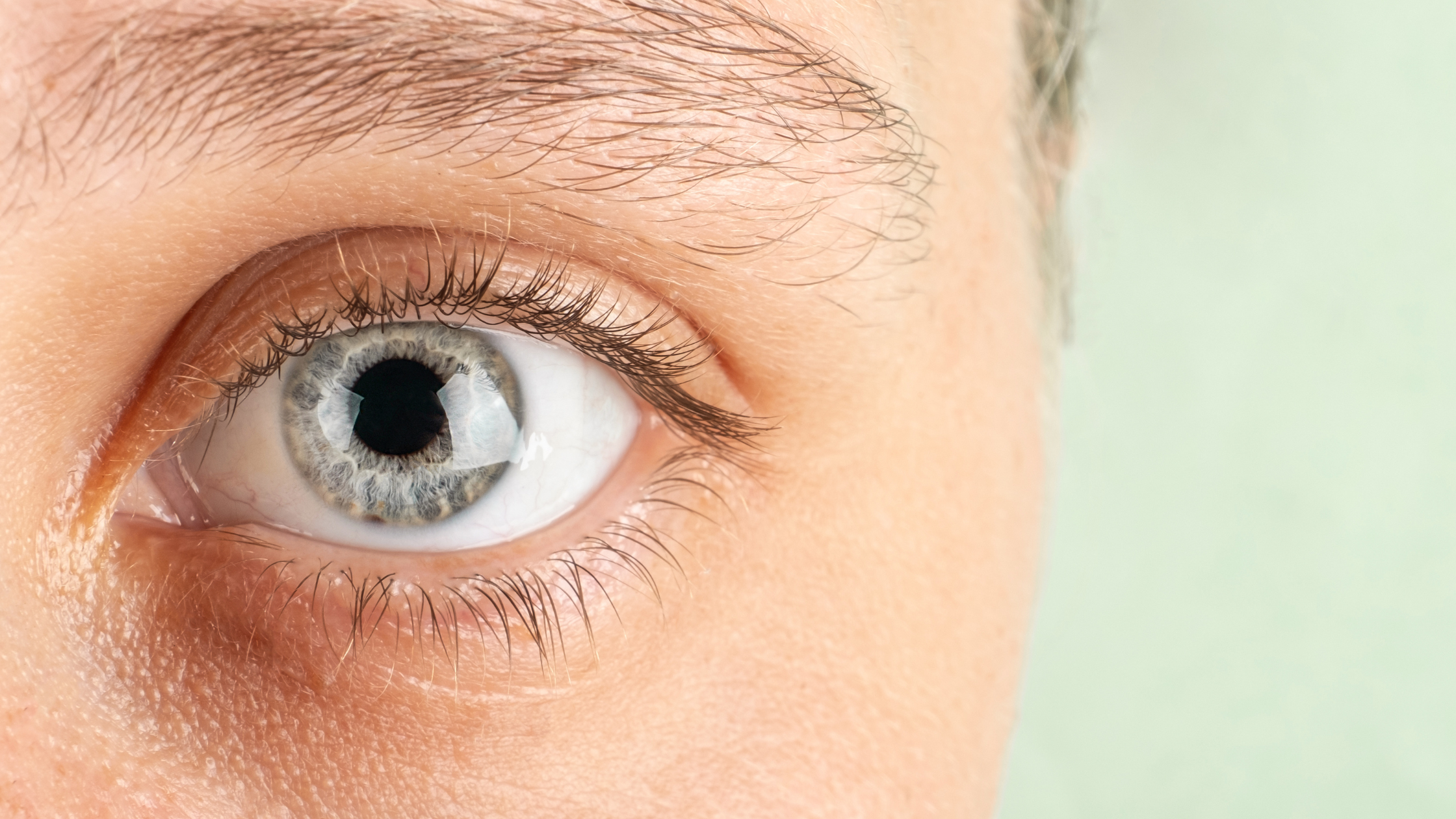 5 Questions You May Have About Keratoconus