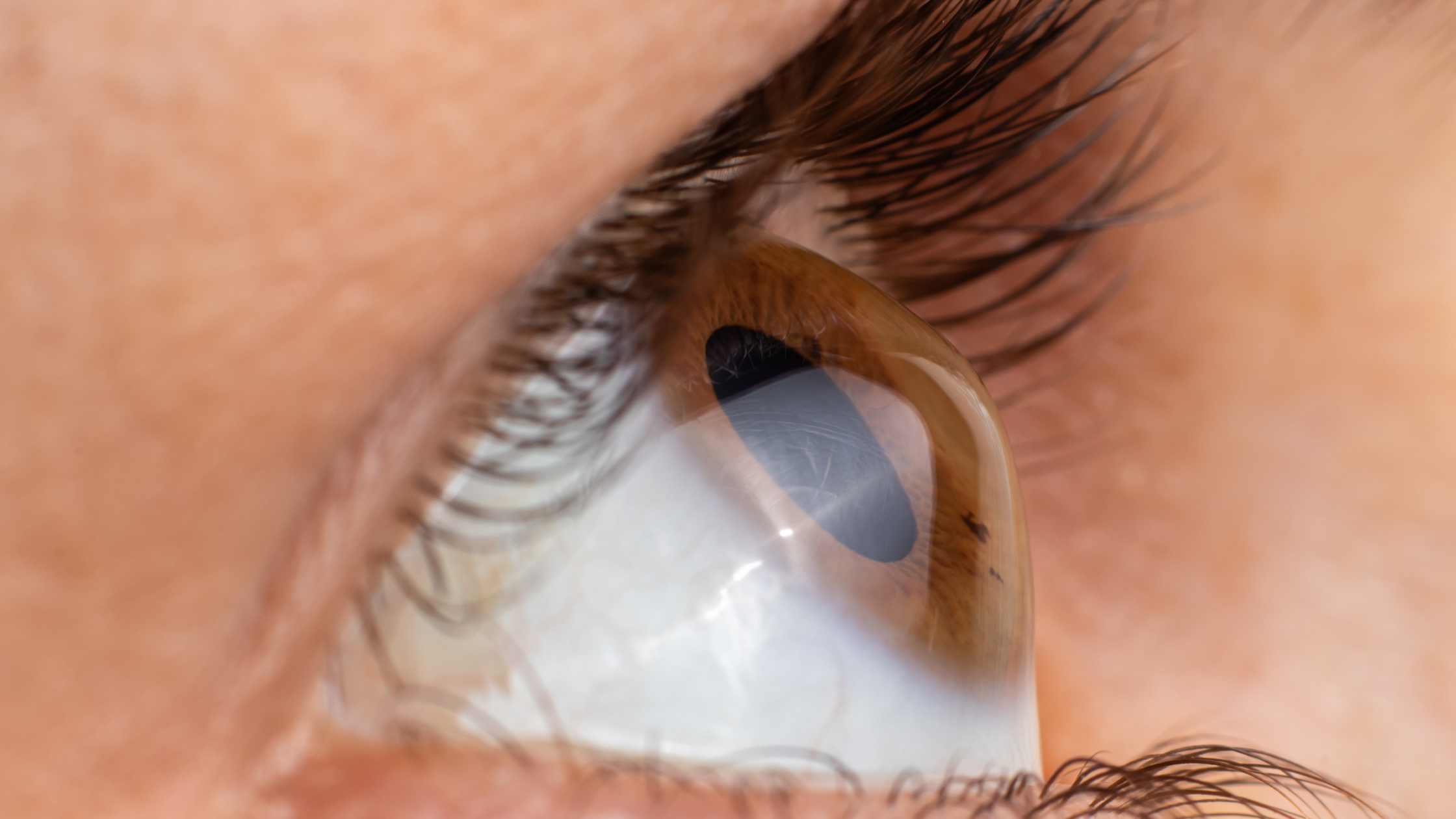 Debunking the Top 7 Myths about Keratoconus