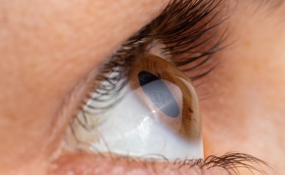 Rose-K and RGP Lenses: Specialized Solutions for Keratoconus