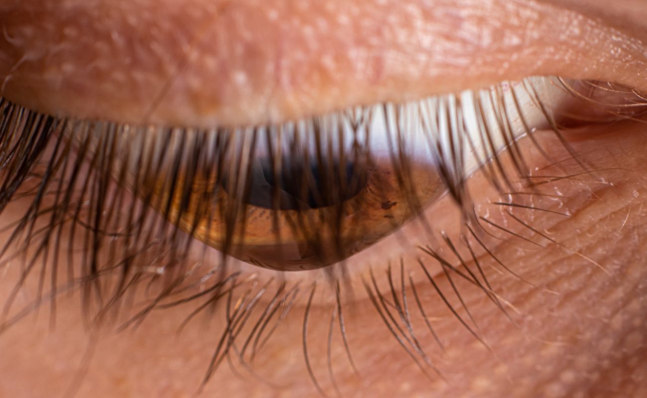 Innovative Design Features of Rose-K Lenses for Keratoconus Management