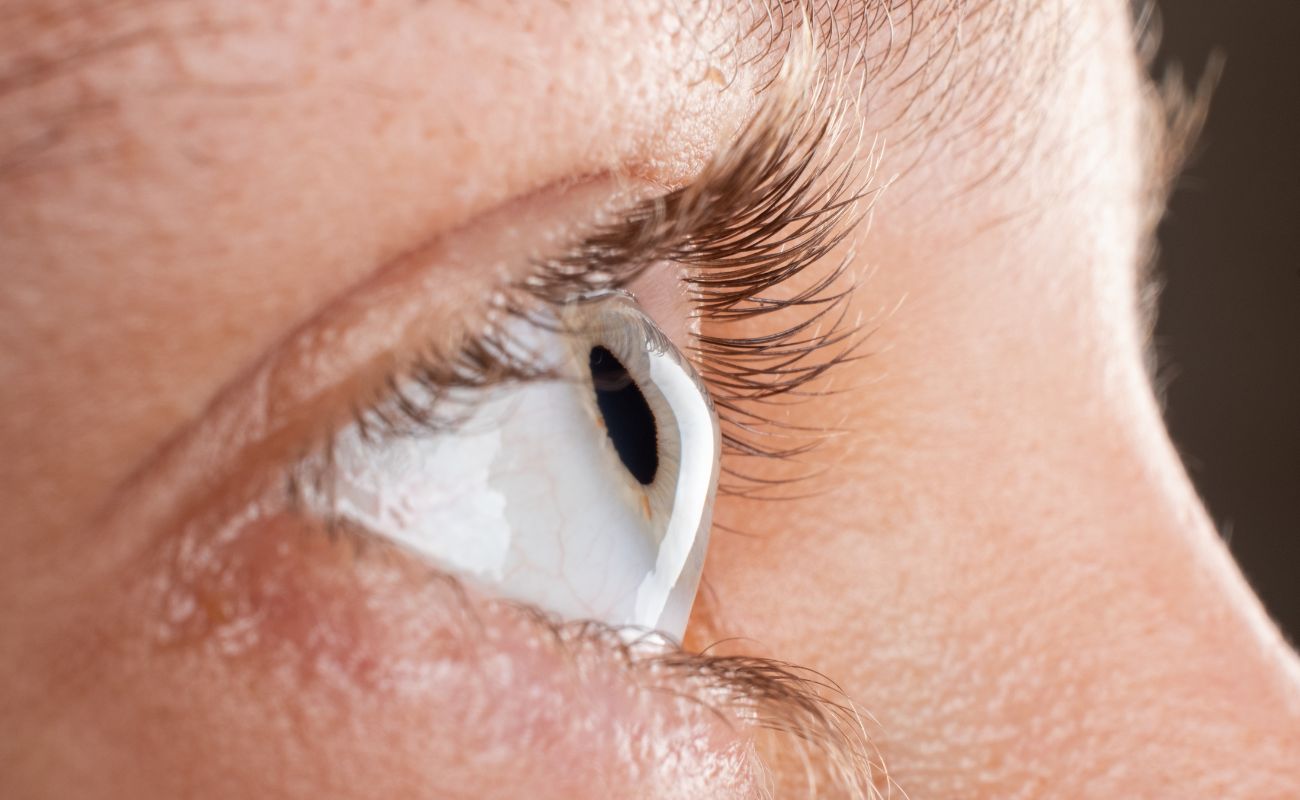 Can Scleral Lenses Be Worn After Corneal Cross-Linking? What Patients Should Know