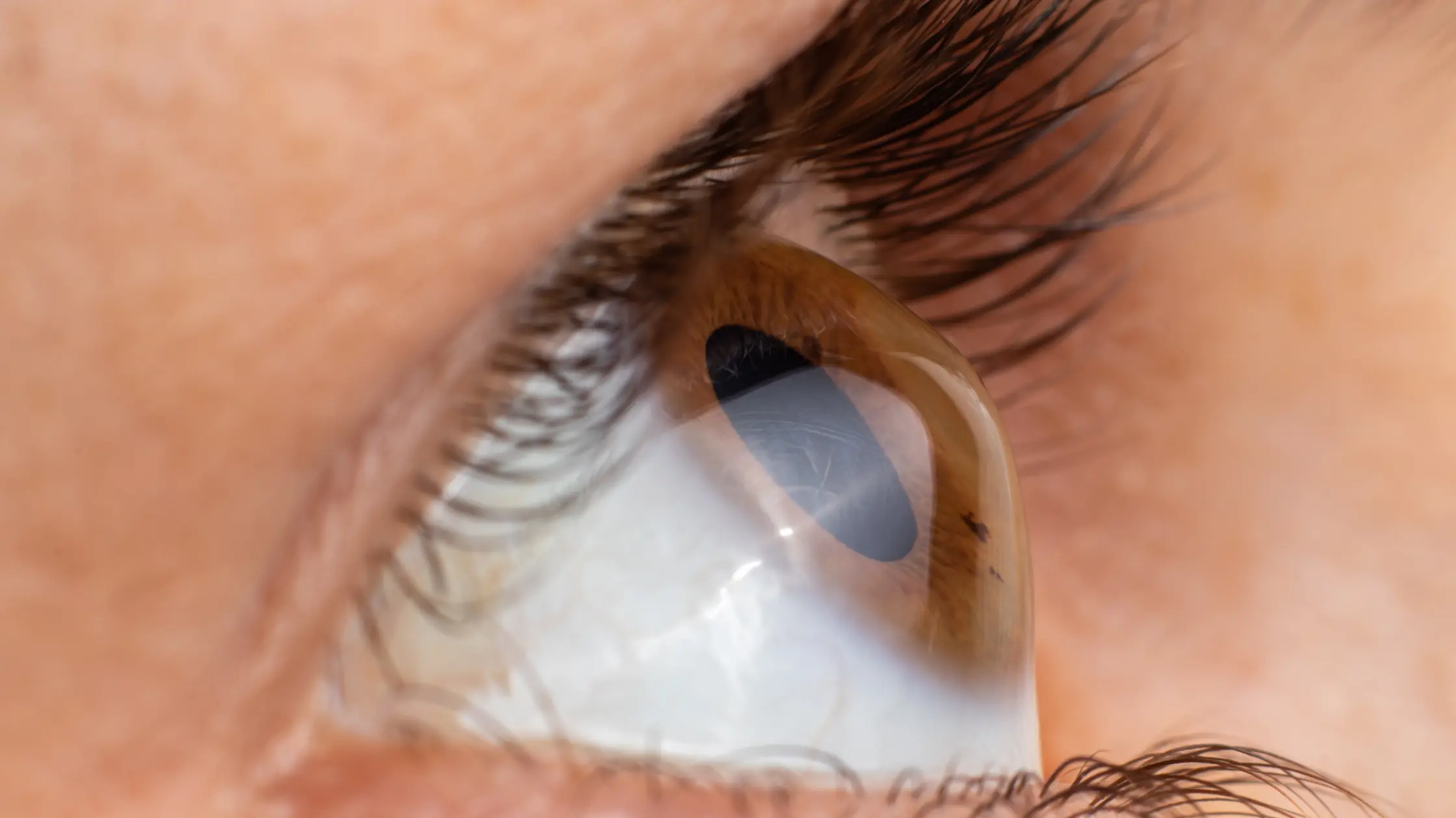 Debunking the Top 7 Myths about Keratoconus
