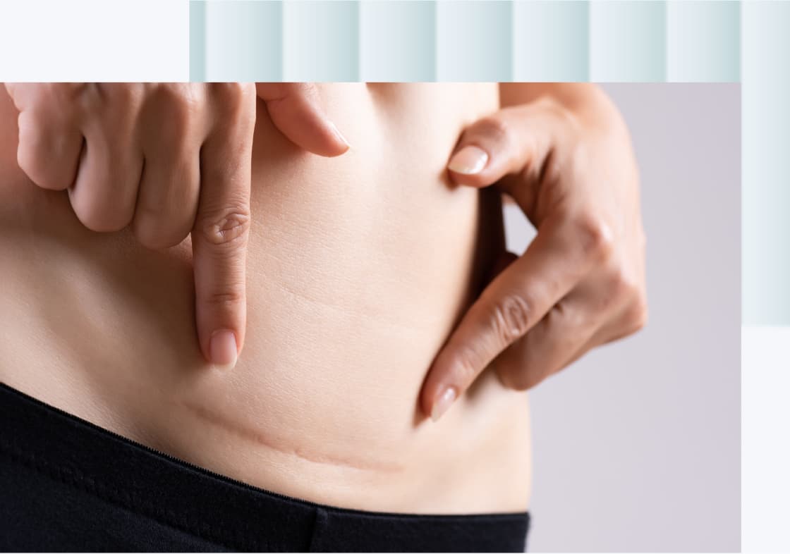 A close-up of a person's abdomen with two fingers pointing to a noticeable scar. The skin appears light in tone, with the scar showing a slightly darker hue.