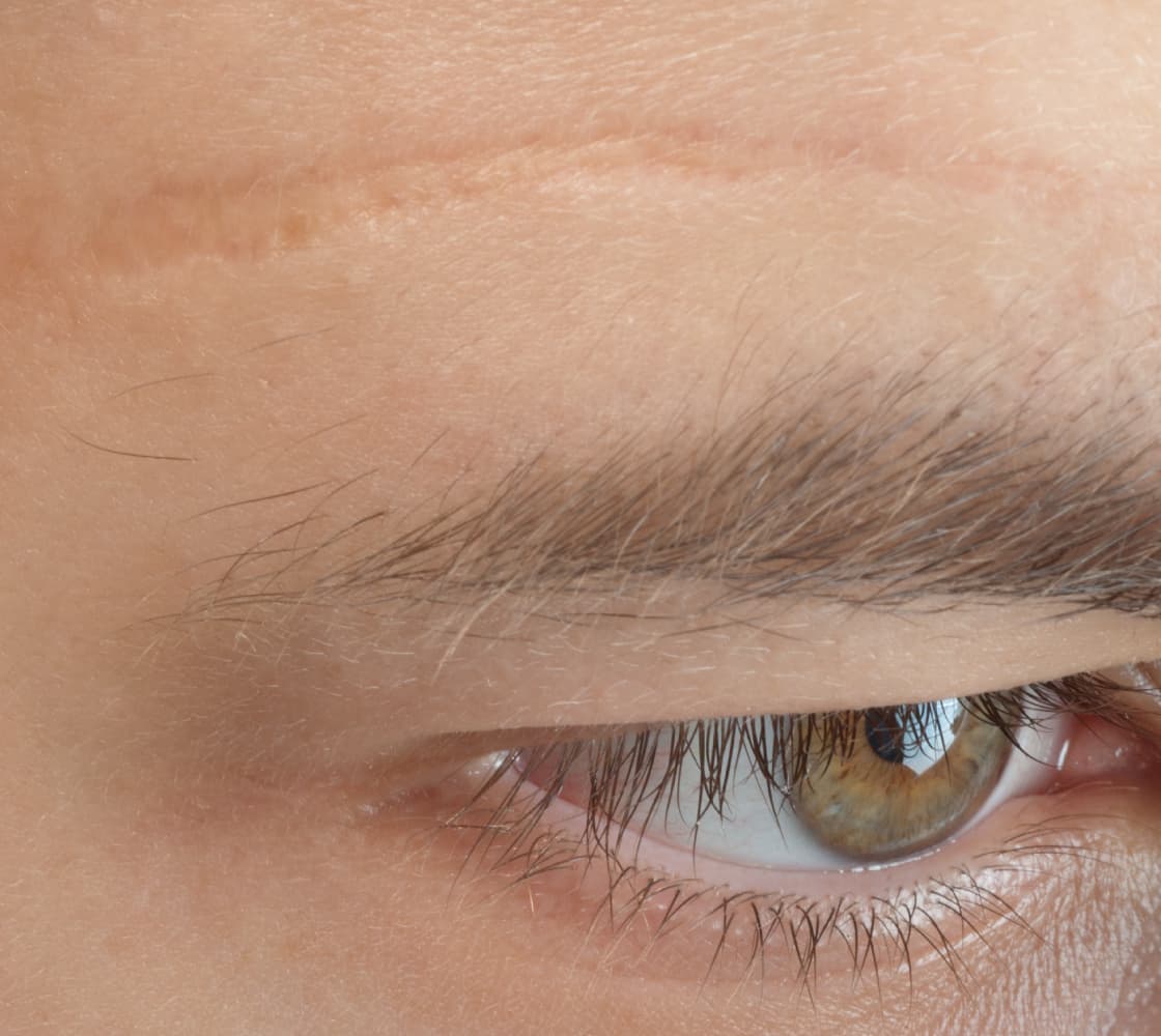 A close-up image of a human eye with a visible scar along the brow area, showcasing the texture of the skin and eyelashes.